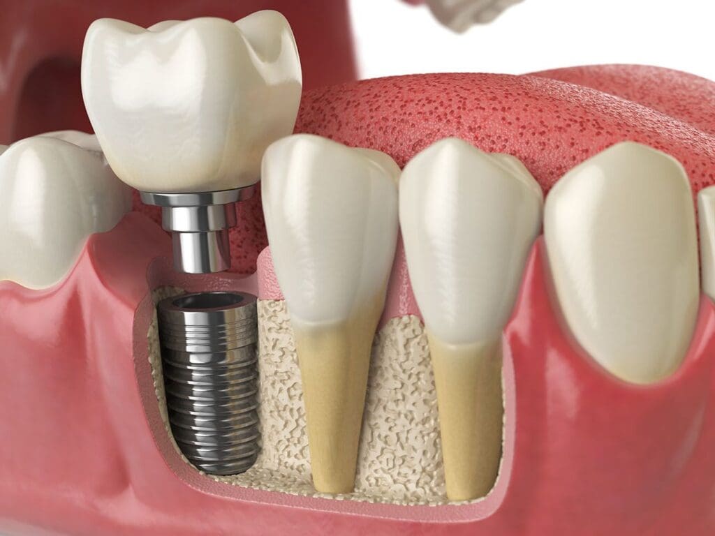 Benefits of Dental Implants in Woodbridge, VA