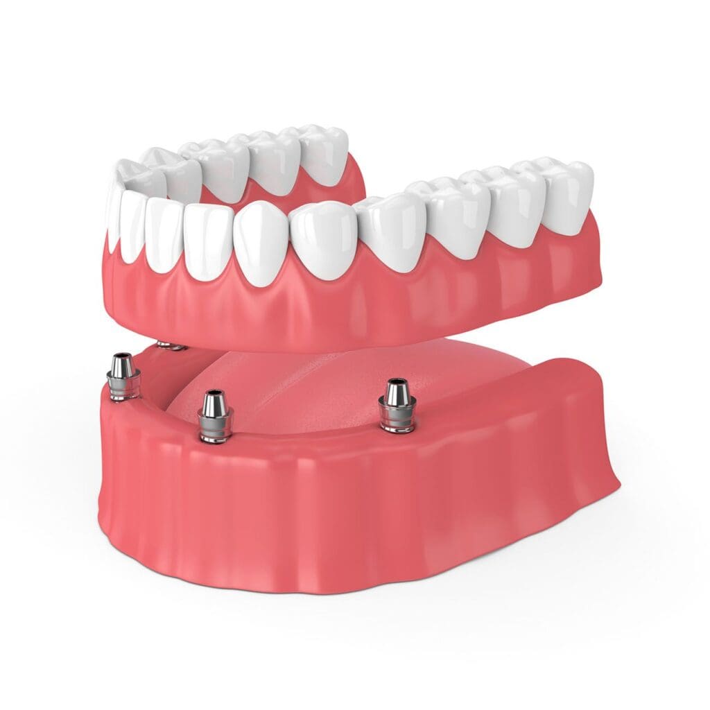 Implant-Supported Dentures in Woodbridge, VA