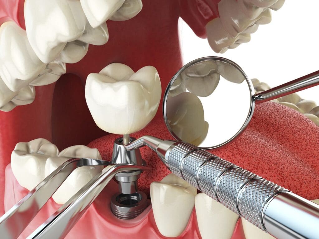 Single-Tooth Dental Implants in Woodbridge, VA